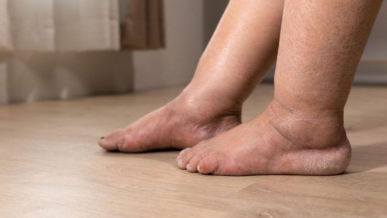 Obrzęk i opuchlizna nóg u seniora – przyczyny i leczenie